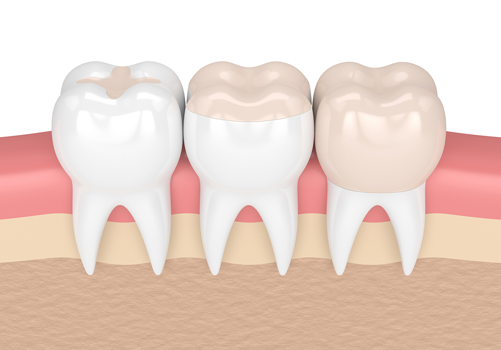 詰め物・被せ物